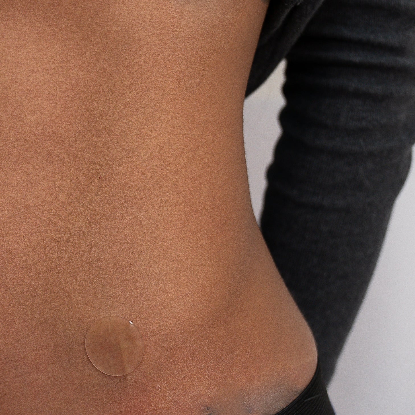 Scar Shield Dot from a liposuction incision