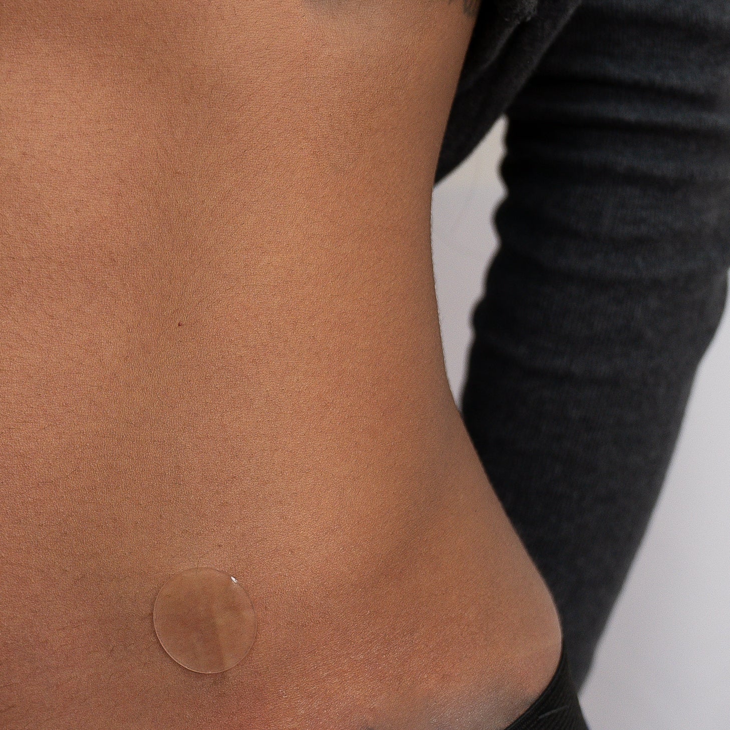 Silicone scar dot placed at abdomen liposuction area