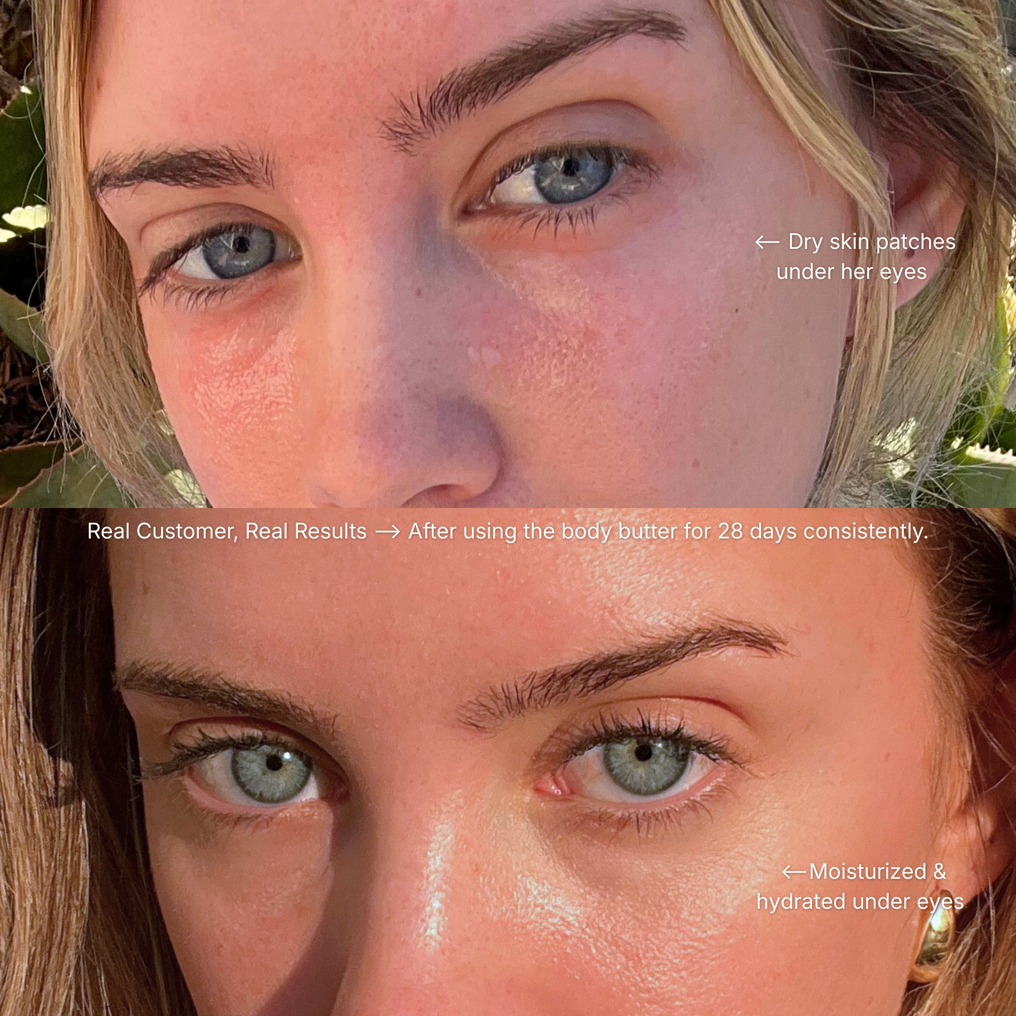 Before and after comparison of a woman's face with dry skin patches under eyes and moisturized skin.