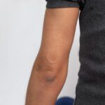 Photo of back of arm, scar shield clear dot on back of arm above elbow, person wearing black shirt against white studio background.